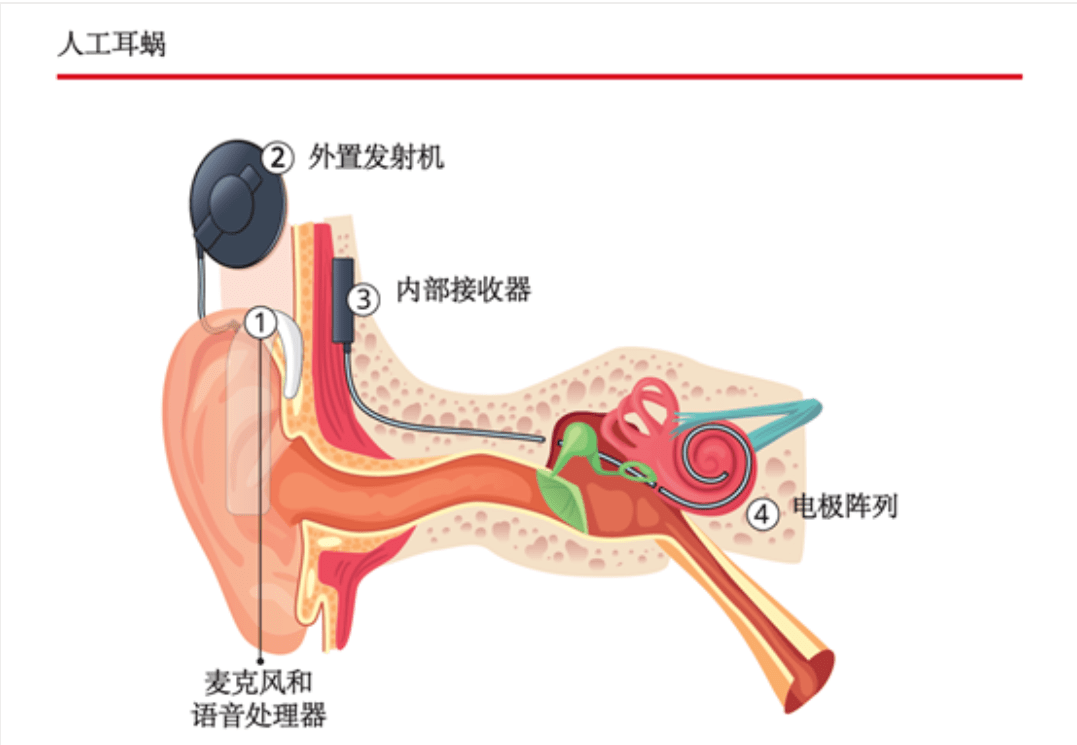 澳洲:追问｜中国医生在澳洲介绍全球首个先天性耳聋基因疗法重大突破